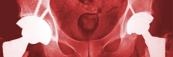 While US Lawsuits Mount, United Kingdom Bans Metal-on-Metal Hip Implants While US Lawsuits Mount, United Kingdom Bans Metal-on-Metal Hip Implants
