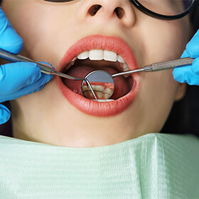 PurelyWhite Lawsuit Says Teeth-Whitening Kits Are Misbranded as FDA-Approved